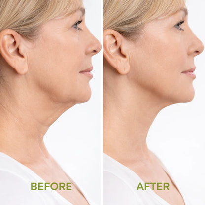 COMBO 2X1 ANTI PAPADA - Mascarilla V Lifting + Reductor de Papada